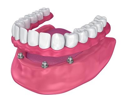 Diagram showing how implant dentures work