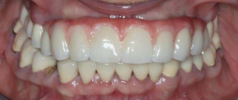 complete smile after dental bridge l dental implants armidale nsw