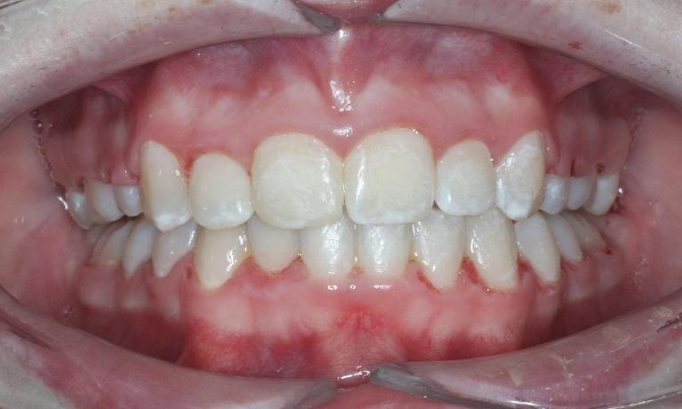 straight smile after dental treatment l orthodontist armidale