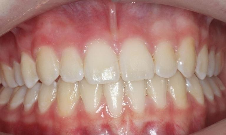 straight teeth after traditional braces l armidale dentist