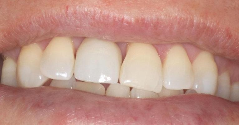 complete smile after dental treatment l dentist near me armidale