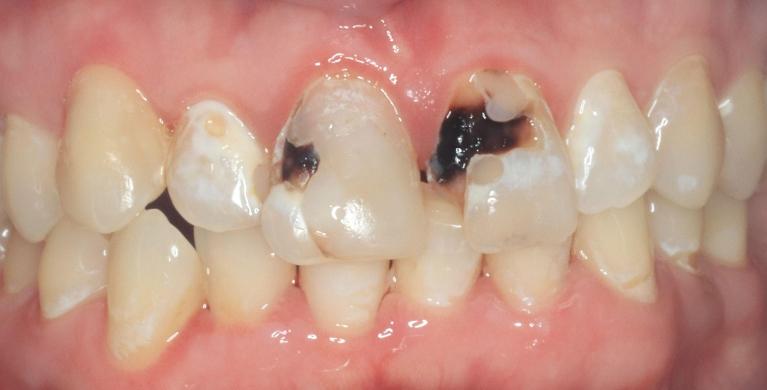 cavity filled teeth before treatment l armidale dentist
