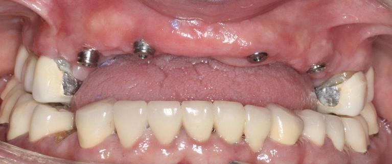 missing teeth before dental treatment l armidale dentist