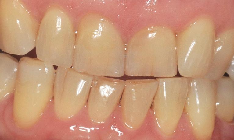 dingy teeth before dental treatment l armidale dental care